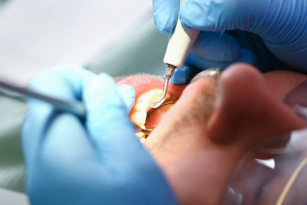 Best Broken or Chipped Tooth Repair in Hoover, AL
